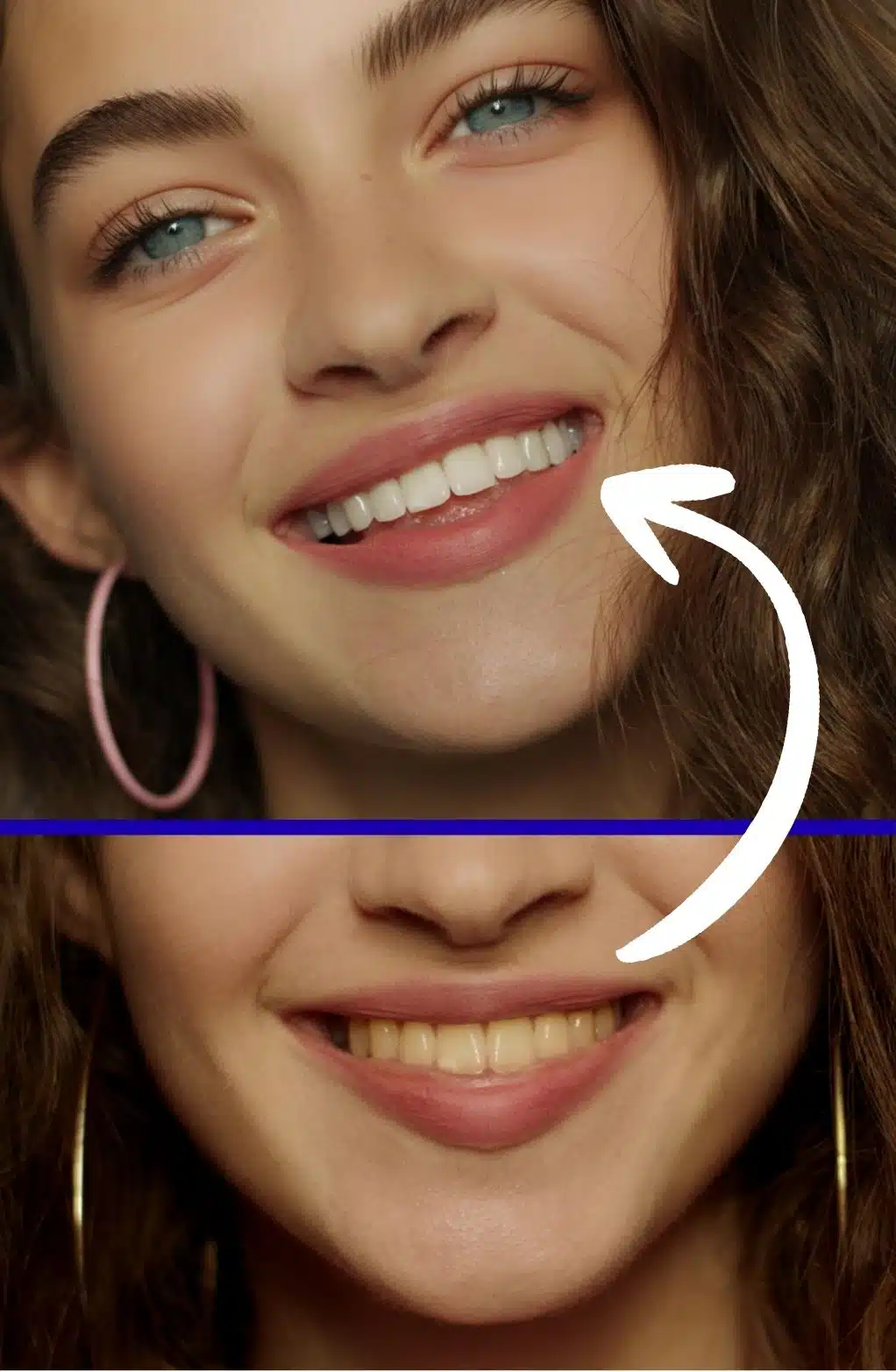 Résultats Avant Après Smilebite Avis